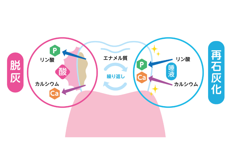 むし歯ができるまで2