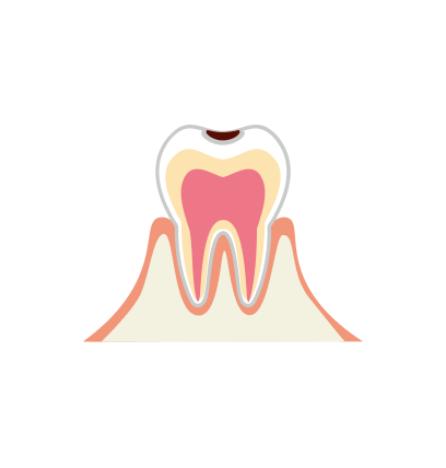 C1【エナメル質のむし歯】