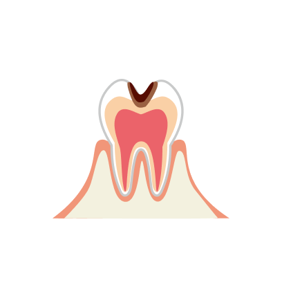 C2【象牙質のむし歯】